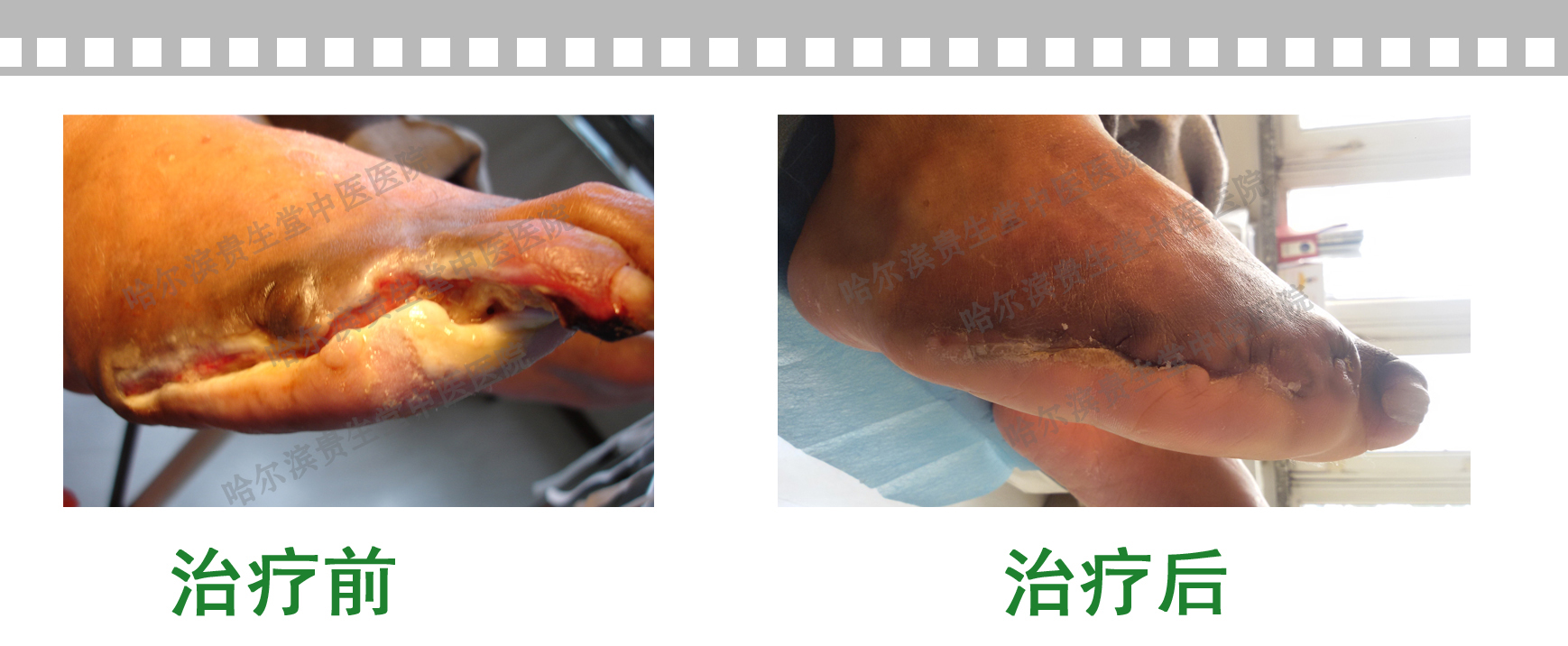 赵某治疗对比图.jpg